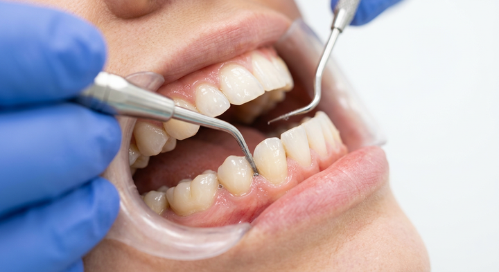 Was Tun bei Aphten: Ursachen, Sofortmassnahmen und Tipps